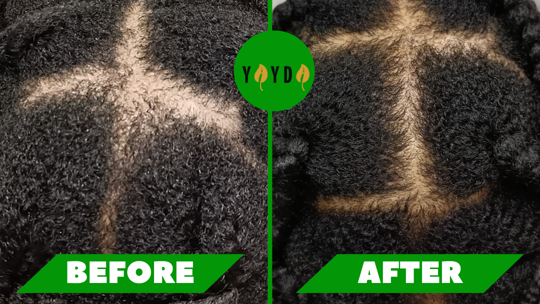 Before and after photo of customer's hair loss