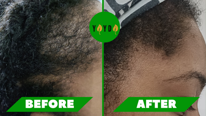 Before and after of customer's hair thinning regrowing