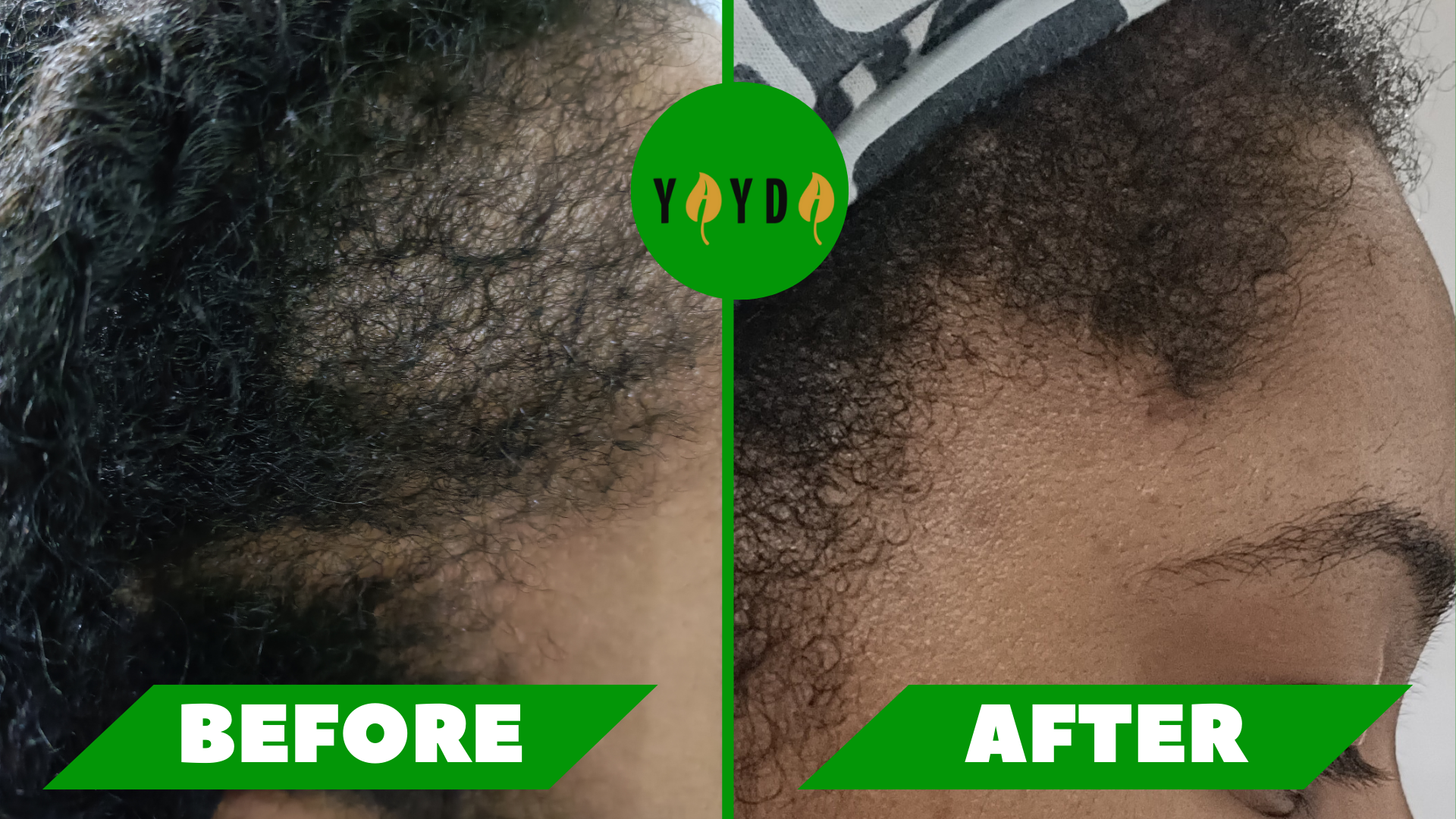 Before and after of customer's hair thinning regrowing